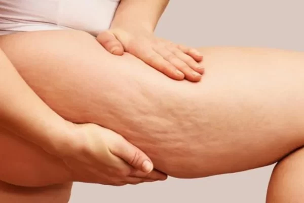 celulitis-k2OC--1200x630@abc